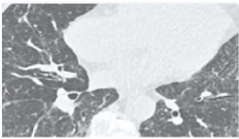 ΔΙΑΜΕΣΗ ΠΝΕΥΜΟΝΟΠΑΘΕΙΑ ΣΕ ΣΚΛΗΡΟΔΕΡΜΑ